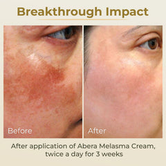 Application douce matin et soir avec ABERA Crème Mélasma sur la peau.