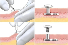 AccGin single-use design supports hygienic and convenient piercing procedures.