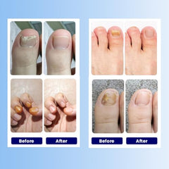 Aedydyce deep nail support with natural extracts in patches