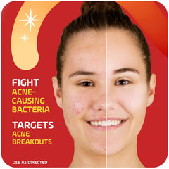 Asepxia tube highlighting the drying formula for quick skin clear-up.