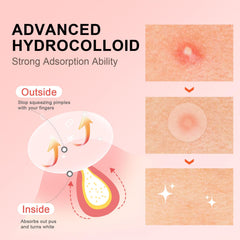 AVJONE hydrocolloid patch adheres to skin for discreet daily wear.