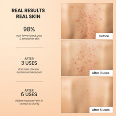 BellamiLuxx body acne scrub butt: helps smooth skin and reduce buildup.