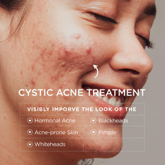 BellamiLuxx cystic acne lotion jar showing gentle daily application for teens and adults.