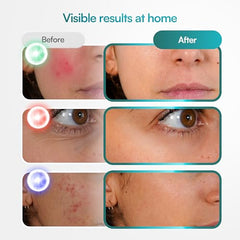 BluMora LED Face Mask comfort-fit image emphasizing soft silicone and adjustable straps