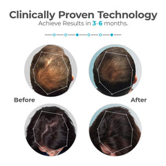 Capillus Plus 202-laser-diode-array powering precise light therapy