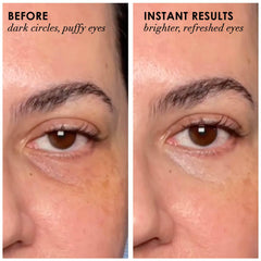 Dermelect Revitalite cool-tip applicator delivering a cooling, soothing eye treatment.