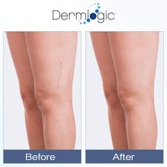 A gentle massage with Dermlogic Arnica Vitamin K Cream on skin to support microcirculation.