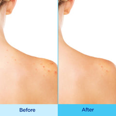 Differin Acne-Clearing Body Spray mist applied to the back for hard-to-reach areas