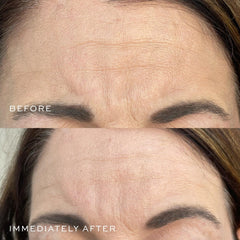 Neck application with DIME serum demonstrating targeted lifting potential