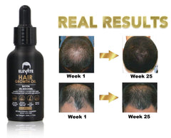 Elevate Minoxidil dropper image shows easy daily use for thinning areas.