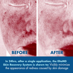EltaMD Skin Recovery System packaging showcases a dermatologist-tested, dye-free formula.