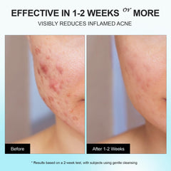 Enaskin Naturals tea tree oil fades post-acne marks and calm redness