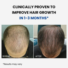 Close-up of ForHair spray being applied to the scalp for targeted growth.