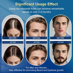 Frnoip minoxidil-foam bottle with screw cap enables clean, mess-free dispensing.