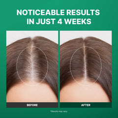Fromforet Spicule roller applicator applying serum to thinning areas precisely.