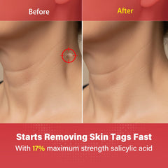 Goodnites Skin Tag Remover dot on skin demonstrating targeted treatment.