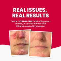 Grahams Natural Rosacea Cream label highlighting natural ingredients