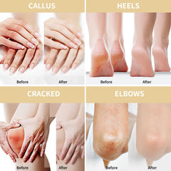 Apply Grocerism Urea Cream to feet and hands for softer calluses.