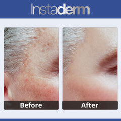 Instaderm application on cheek promoting even-toned skin.