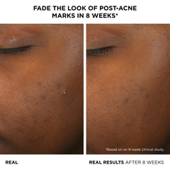 IT Cosmetics Bye Bye Breakout Serum drops on finger for quick absorption.