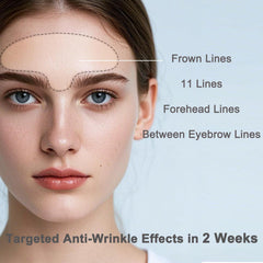 Iyxicmi patch on glabellar lines showing precise fit for frown lines