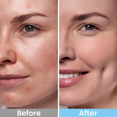 Kestper Witch Hazel Pads closeup reveals soothing botanical blend.