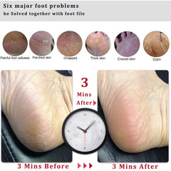 Kinepi foot callus remover works wet or dry for versatile use.