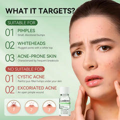 LANBENA Acne Spot Serum application on the face demonstrating spot treatment