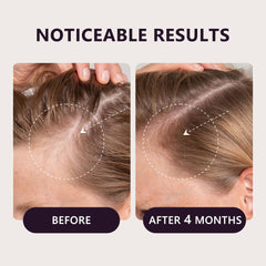 LONGCCI minoxidil 5% formula may support fuller-looking hair with consistency.