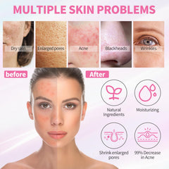 LXSKN Daily Acne Essentials Kit clay mask; absorbs impurities for radiant balance.