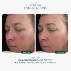 Marini SkinSolutions RosaLieve tetrapeptide-14 smooths texture for a calmer complexion.
