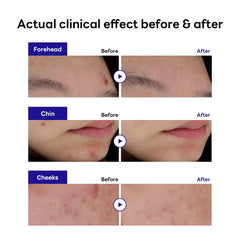Mediheal Derma Clear patch with Madecassoside and Niacinamide soothes irritated skin and improves tone.