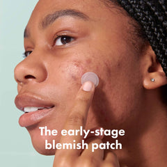Mighty Patch Micropoint Large patch applied to a blemish for targeted spot treatment