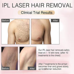 MiSMON laser hair removal arms for quick home grooming sessions