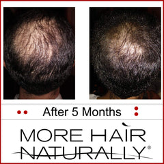 More Hair Naturally 9 clinical-strength formulation combines stem cells and botanicals.