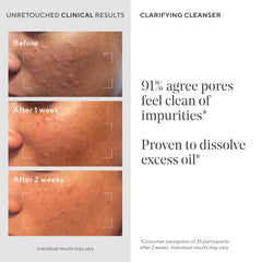Close-up of pores before cleansing with Murad Acne Control Clarifying Cleanser.