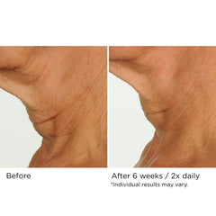 NassifMD Deco-Lift application demonstrating upward strokes on the neck