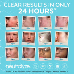 Neutralyze acne treatment kit packaging for complete routine.