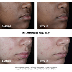 Neutrogena Stubborn Acne AM Treatment absorbed into skin with light, non-greasy finish.