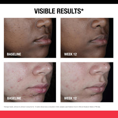 Applying Neutrogena Stubborn Marks PM Treatment on skin during nighttime routine.