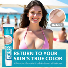 NHZ Vitiligo Cream closeup shows creamy texture for depigmented areas.