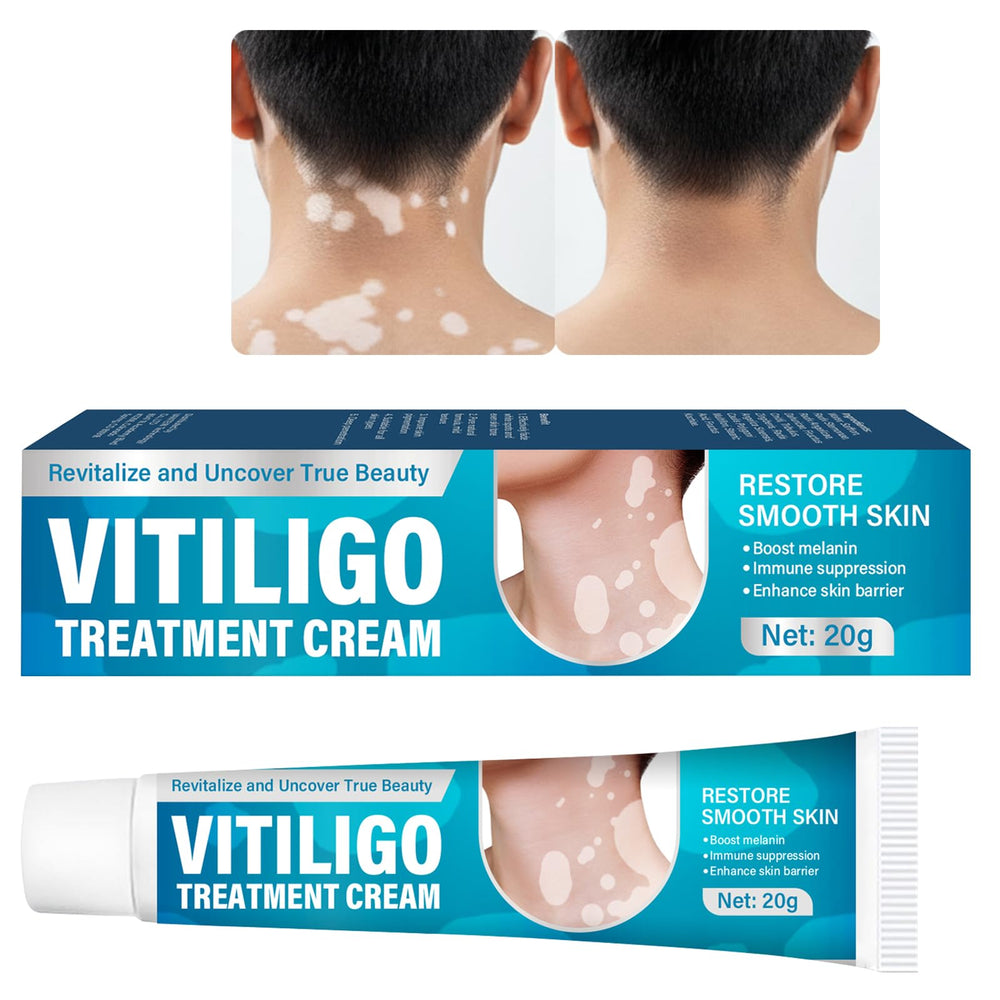 NHZ Vitiligo Cream targets white spots for a more even skin appearance.