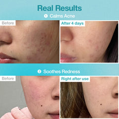 Numbuzin No.1 sheet mask sachet close-up emphasizing potent essence for acne-prone skin.