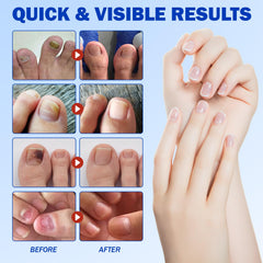 Nyloriaine patches on nail area showing secure adhesion.