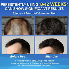 Olassubd Minoxidil foam dispense enables precise, mess-free application.