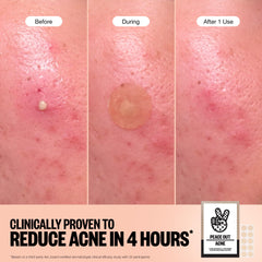 Peace Out Acne Healing Dots close-up texture on skin, thin and discreet for daily wear.