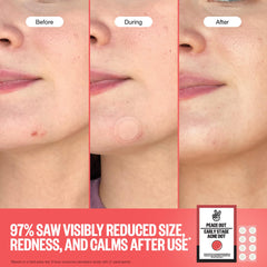 PEACE OUT Early Stage Acne Dots worn on the face in daily routine