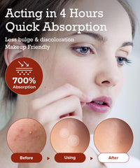 PIMPLE LAB hydrocolloid patch absorbs fluids from blemishes without bulk.