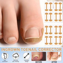 Professional Pedicure Tools ingrown toenail kit precision file supports careful maintenance