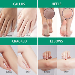 SACLLCAS Urea Cream 40% no odor, comfortable wear.